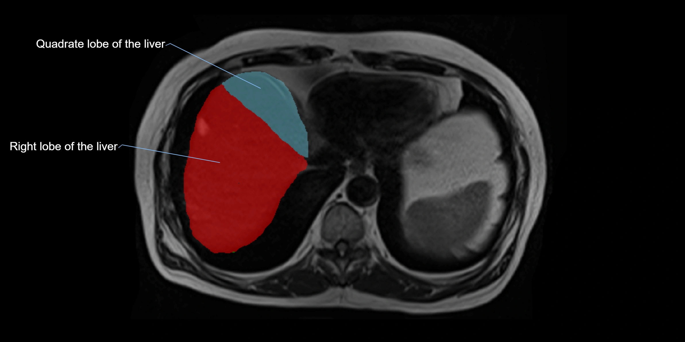 MRI liver lobe axial cross sectional 3T radiology  image-img-00001-00005.webp